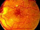 Foto: retina affetta da amaurosi congenita di Leber