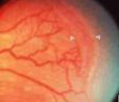 Retina di un neonato prematuro colpito da retinopatia