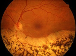 Retina di persona colpita da retinite pigmentosa