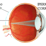 occhio-ipermetropia_corretta_con_lente-web.gif