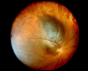 melanoma oculare