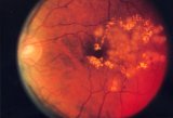 Retina affetta da retinopatia diabetica