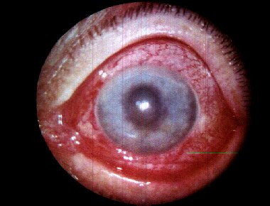 occhio glaucomatoso