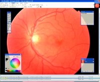 retinografia digitale