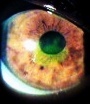 Ulcera della cornea (evidenziata in verde con la fluorescina)