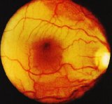 Occlusione vascolare retinica (arteria centrale)