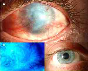 In alto: occhio colpito da ammoniaca. In basso: occhio sano (a destra) e anomalie della cornea occhio causticato (a sinistra)