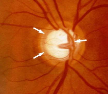 Le frecce indicano la testa del nervo ottico, colpita da degenerazione anche in caso di glaucoma