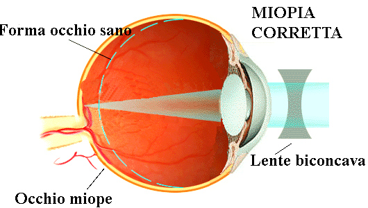 Correzione della miopia