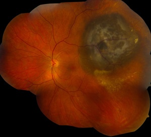 Melanoma oculare (Fonte: Washington University St. Louis)