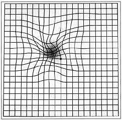 Test di Amsler: i malati di AMD osservano una deformazione delle linee rette in prossimità del centro del campo visivo e una macchia più scura o di non visione