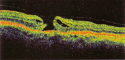 Foro maculare della retina (Immagine ottenuta con OCT)