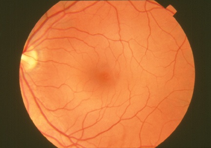 Retina (fondo oculare)