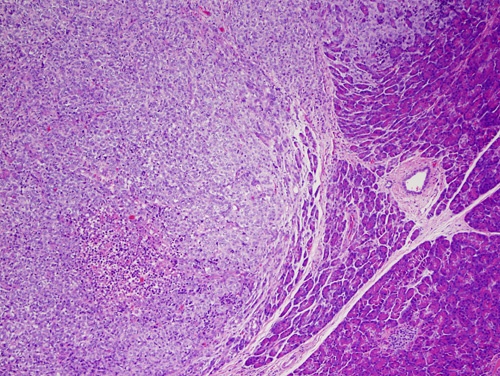 Metastasi pancreatica (Foto: NCI, R.Lee)