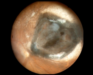 Fondo oculare dopo impiego di placche radioattive (brachiterapia) contro il melanoma