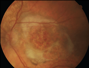 Fondo oculare di malato di AMD neovascolare (immagine: JAMA)
