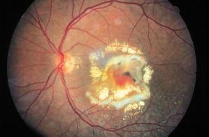 Danni retinici provocati dalla degenerazione maculare legata all'età (forma umida)