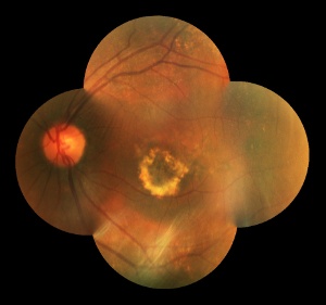 AMD secca (malattia degenerativa del centro della retina)