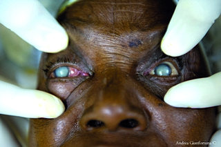 Persona affetta da cataratta in Burkina Faso (Foto cortesia di A. Gianfortuna-copyright)