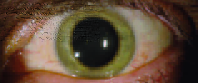 Il colore di un occhio di Ian Crozer è cambiato (da azzurro a verdastro) a causa del virus Ebola