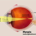 Il bulbo oculare di un miope è più allungato della norma è il punto di fuoco cade davanti alla retina (Fonte nei.nih.gov)