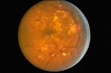 Fondo oculare di persona affetta da retinopatia diabetica