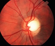 glaucoma sintomi 