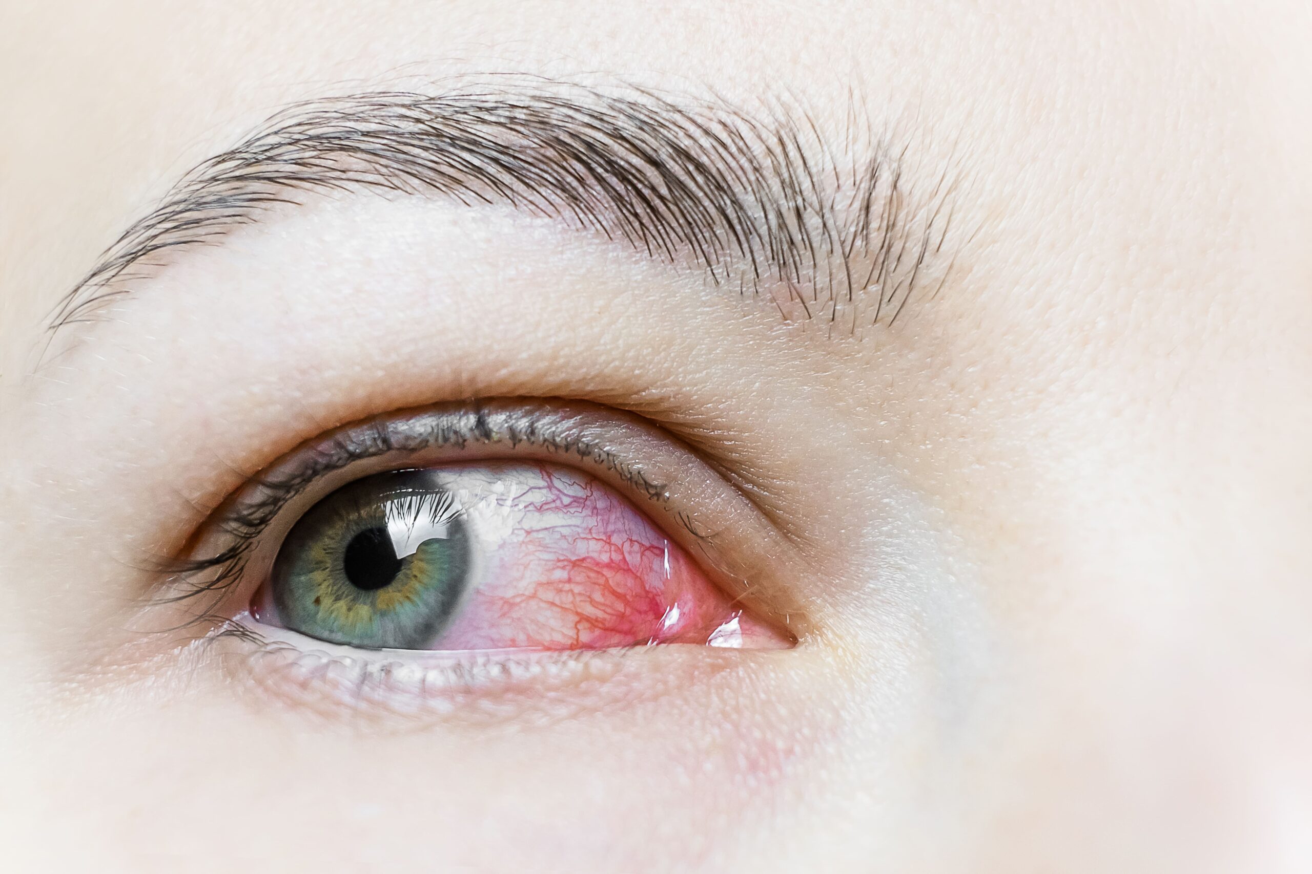 infezioni oculari
