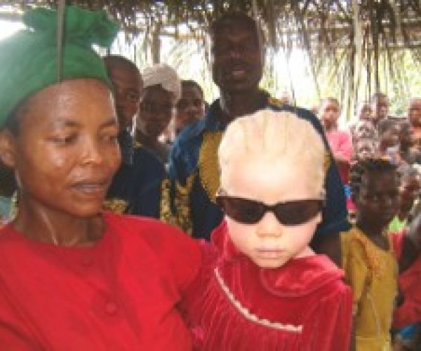 Bimba albina con la madre in Congo