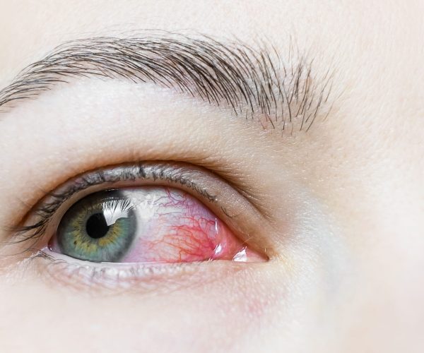 infezioni oculari