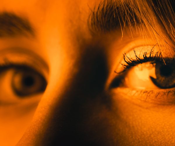 glaucoma
